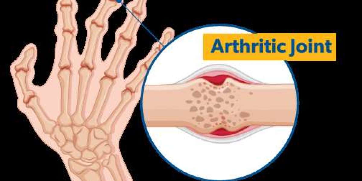 Effective Home Remedies for Alleviating Arthritis Hand Pain