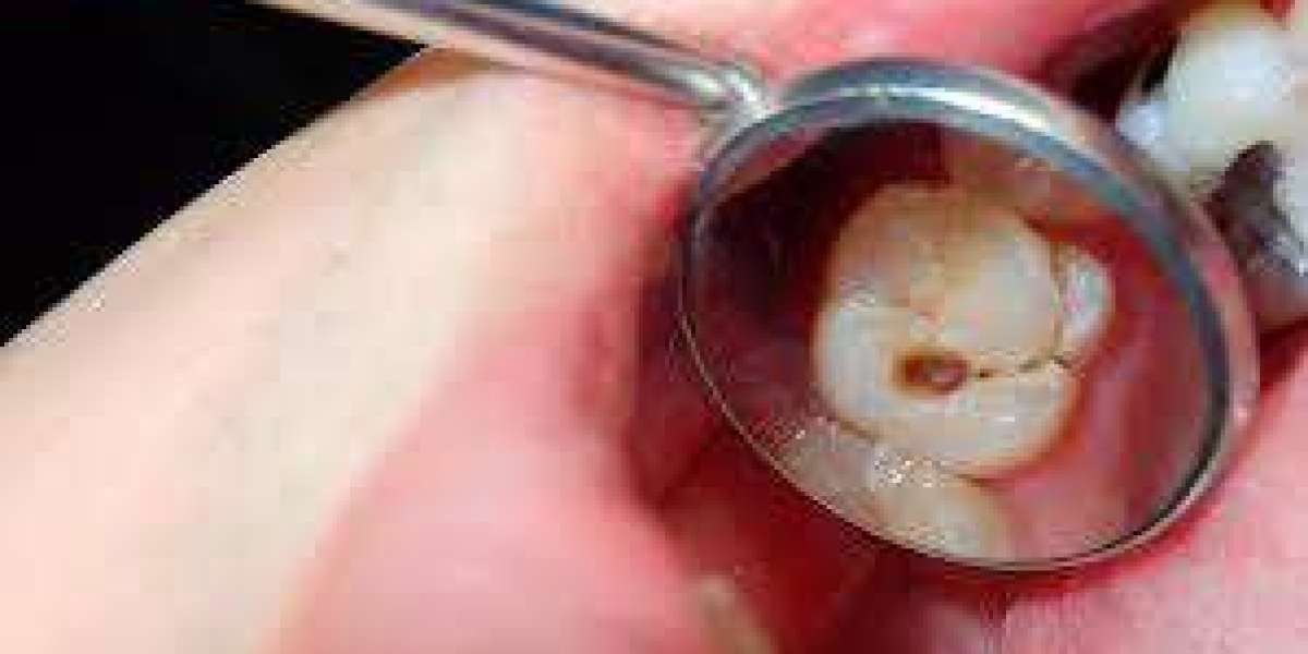 Comparing the Incidence of Infections in Different Dental Implant Materials