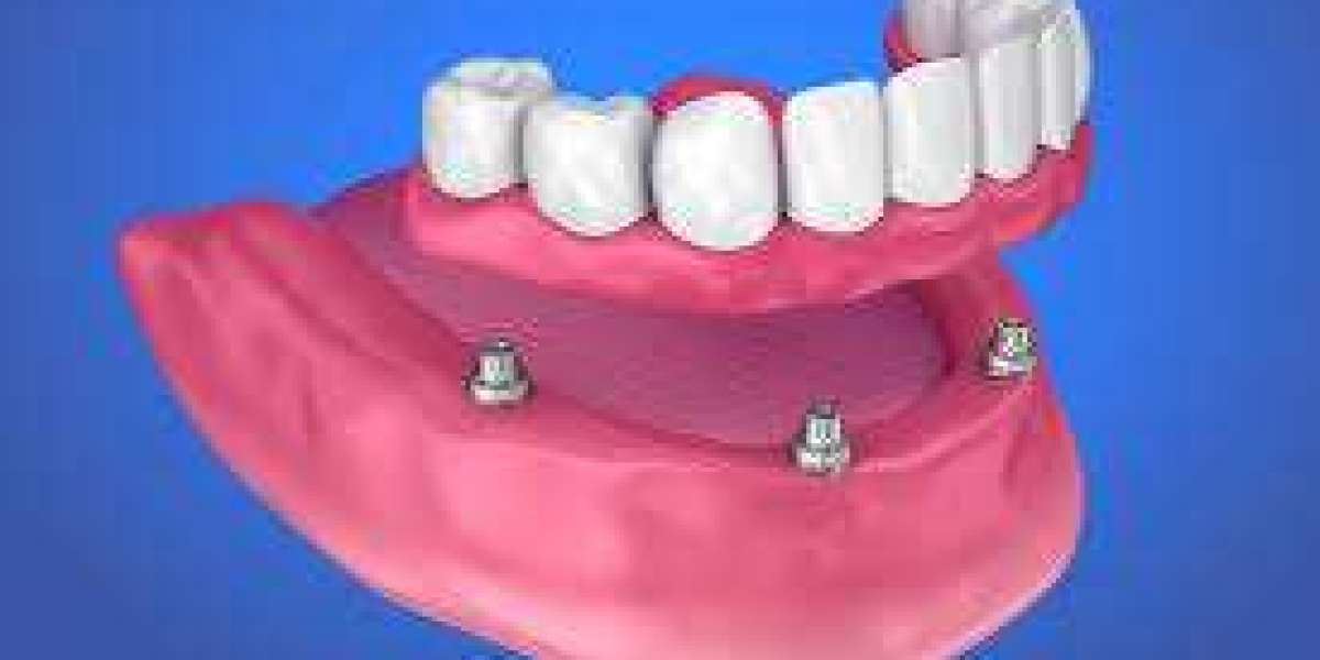 How to Adjust to Life with Dentures: Practical Advice