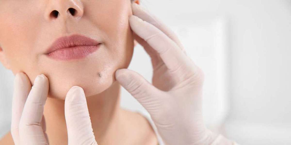 Is Mole Removal Treatment in Dubai Safe and Effective?