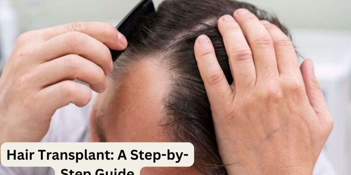 Hair Transplant: A Step-by-Step Guide