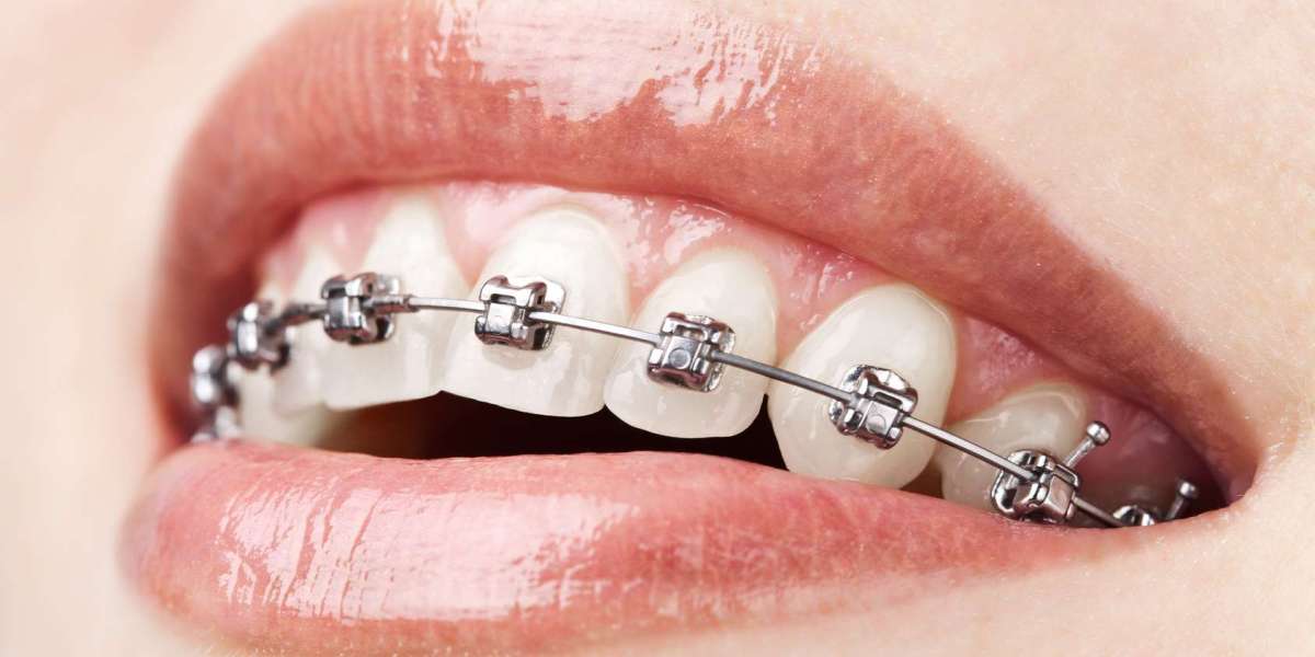 The High Prevalence of Malocclusion is Driving the Demand for Orthodontics