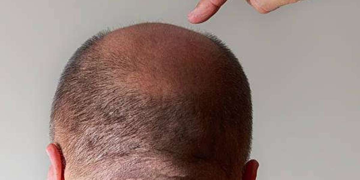 Unveiling Hair Transplant Cost in Abu Dhabi: All You Need to Know