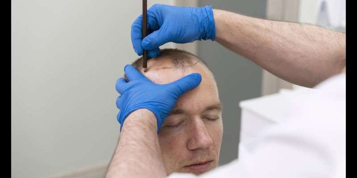 From Scalp to Success: PRP Hair Treatment Trends in Riyadh