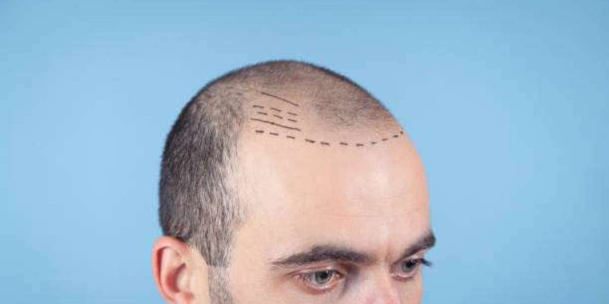 Hidden Expenses: What to Look Out for in Hair Transplant Pricing
