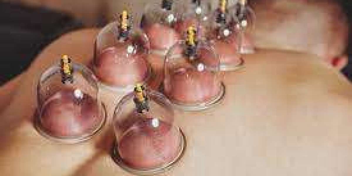 Exploring the Ancient Art of Cupping Therapy in Dubai