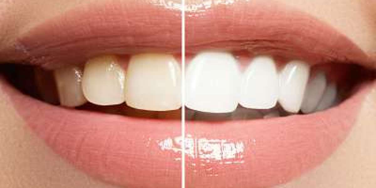 Restore Your Sparkle: Teeth Whitening Treatments in Abu Dhabi