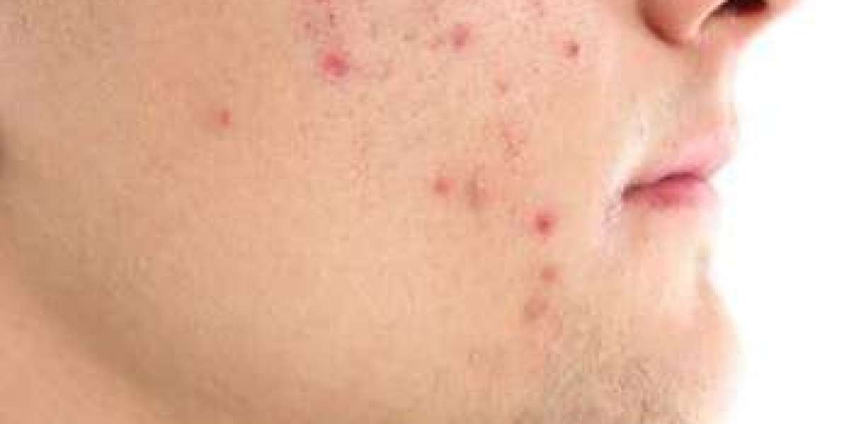 Banishing Blemishes: Acne Treatment Solutions in Abu Dhabi