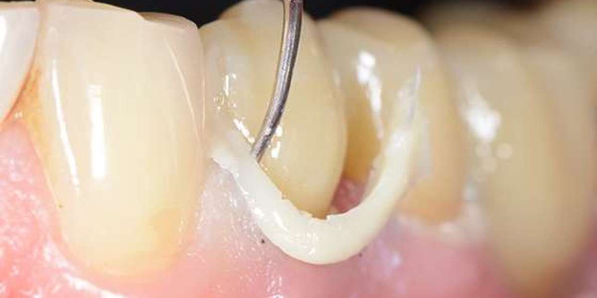 DIY Dental Bonding: Myth or Reality?