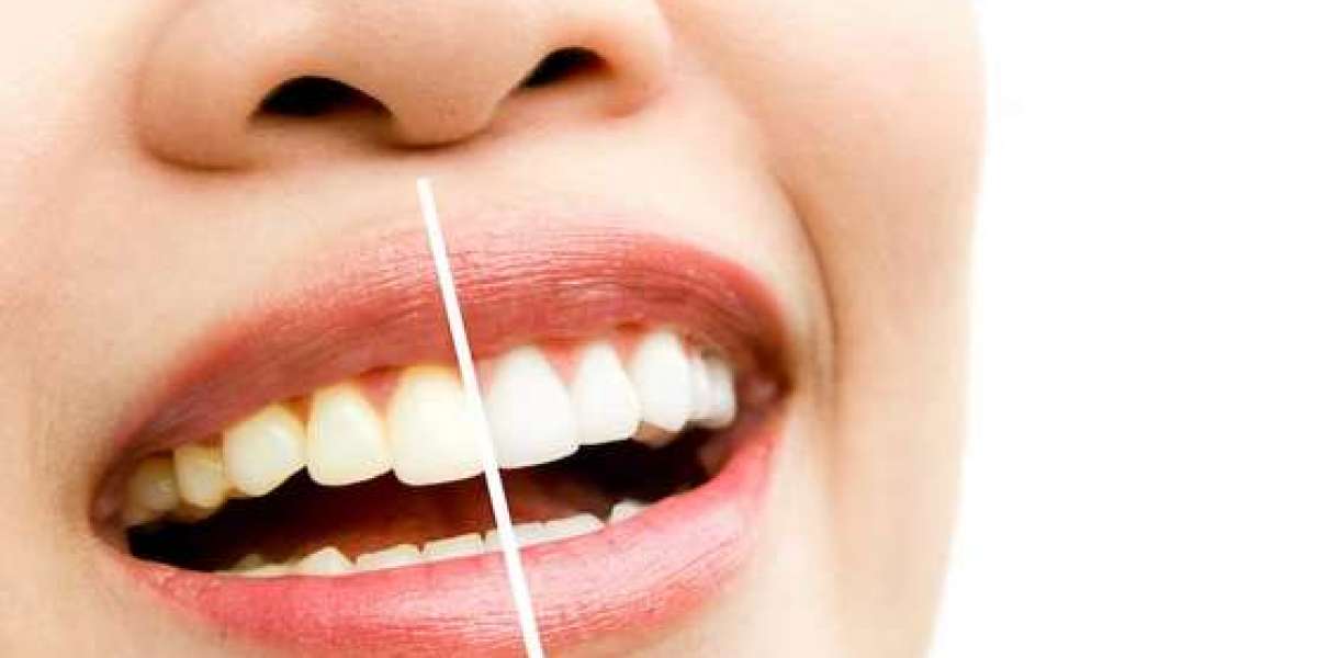 Laguna Niguel's White Magic: A Comprehensive Review of Teeth Whitening Services