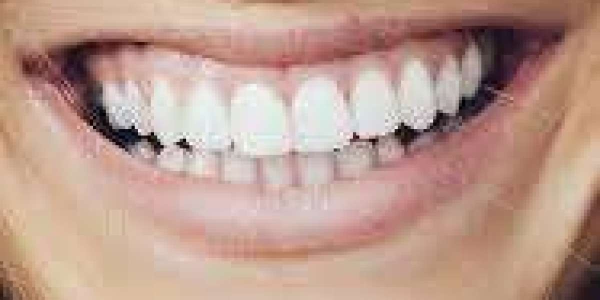 Case Studies: Successful Gummy Smile Treatments and Patient Experiences