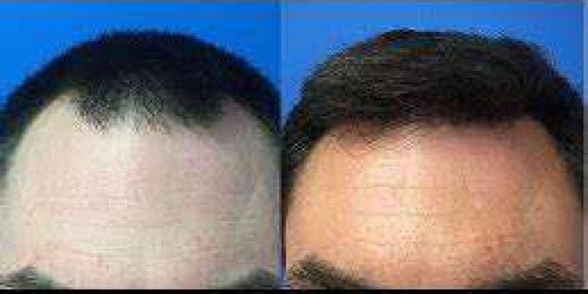 Reclaiming Your Confidence: A Comprehensive Guide to Hair Transplant in Riyadh