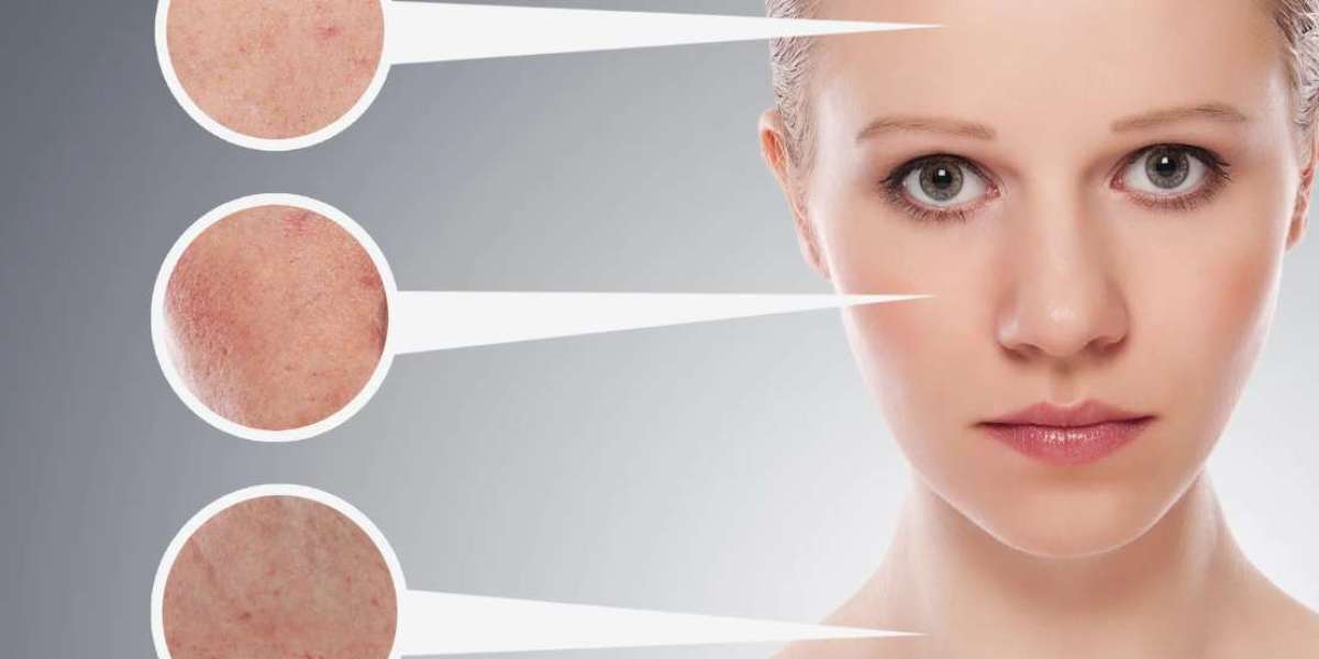 Illuderma - "Top Benefits" Eliminates Skin Acne, Wrinkles!