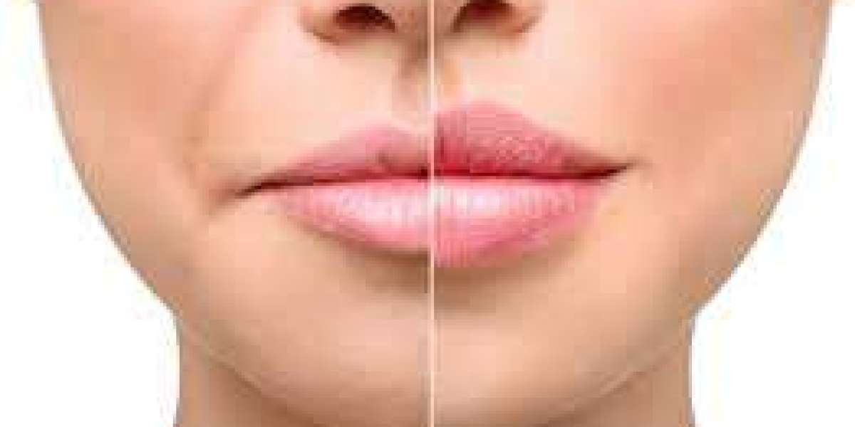 The Buzz around Lip Filler Injections in Dubai: A Closer Look at the Trend
