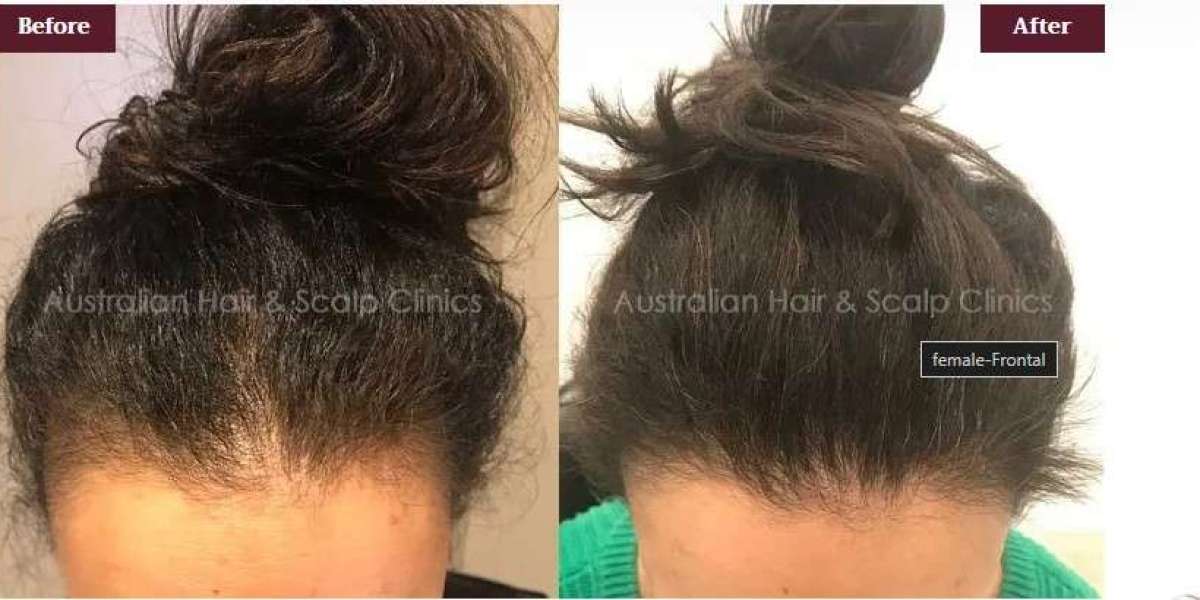 The Herbal Pathway to Cure Female Pattern Baldness in Melbourne