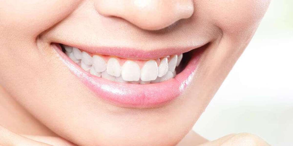 دليل الابتسامة اللامعة: إتقان تقنيات تبييض الأسنان