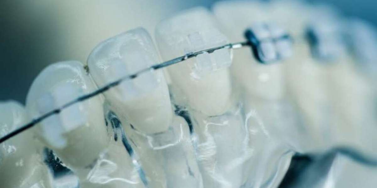 3D Printed Dental Brace Market Size, Share, Growth, Analysis, and Forecast to 2030