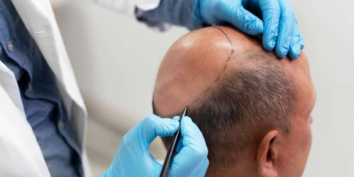 Hair Loss Solutions: Exploring Hair Transplant in Dubai