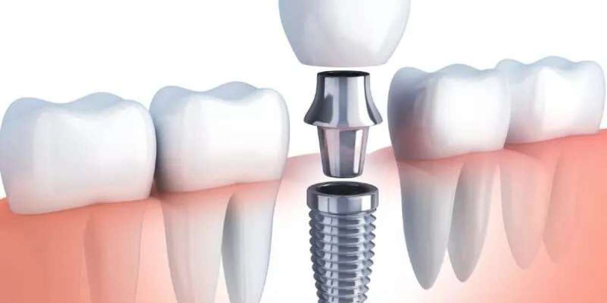 Navigating Tooth Replacement Costs: Comprehensive Services in McKinney, TX