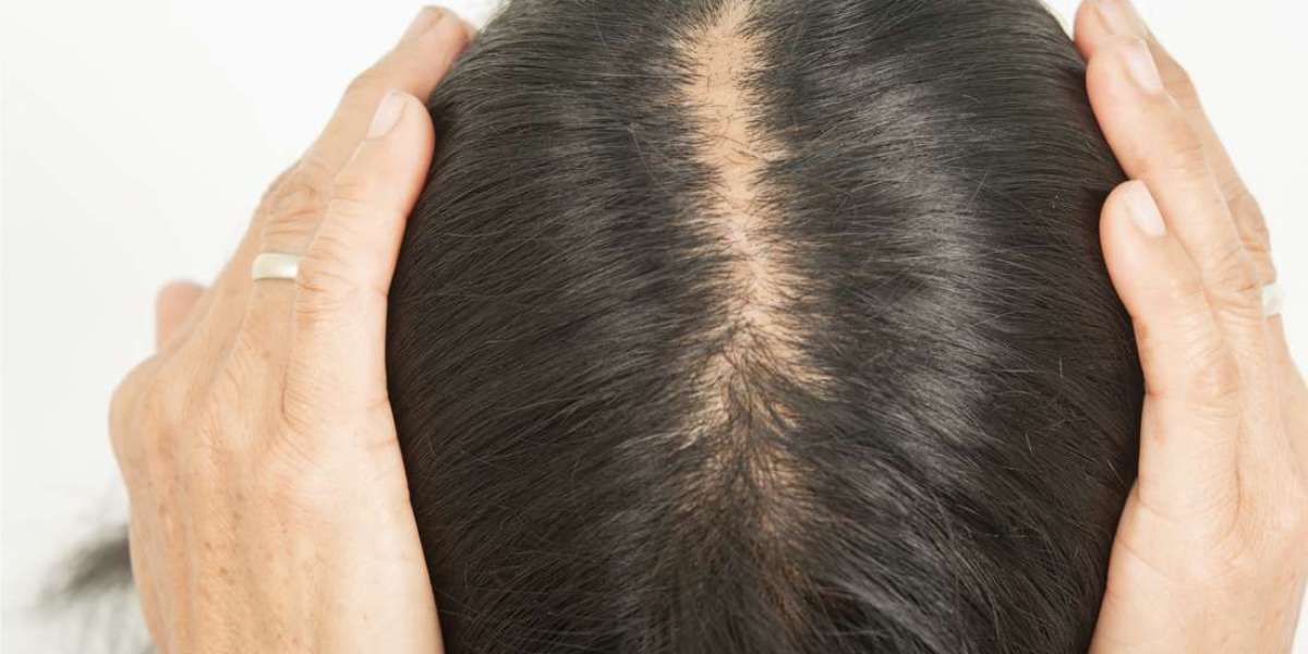 Defying Baldness: Advanced Hair Loss Treatments in Dubai