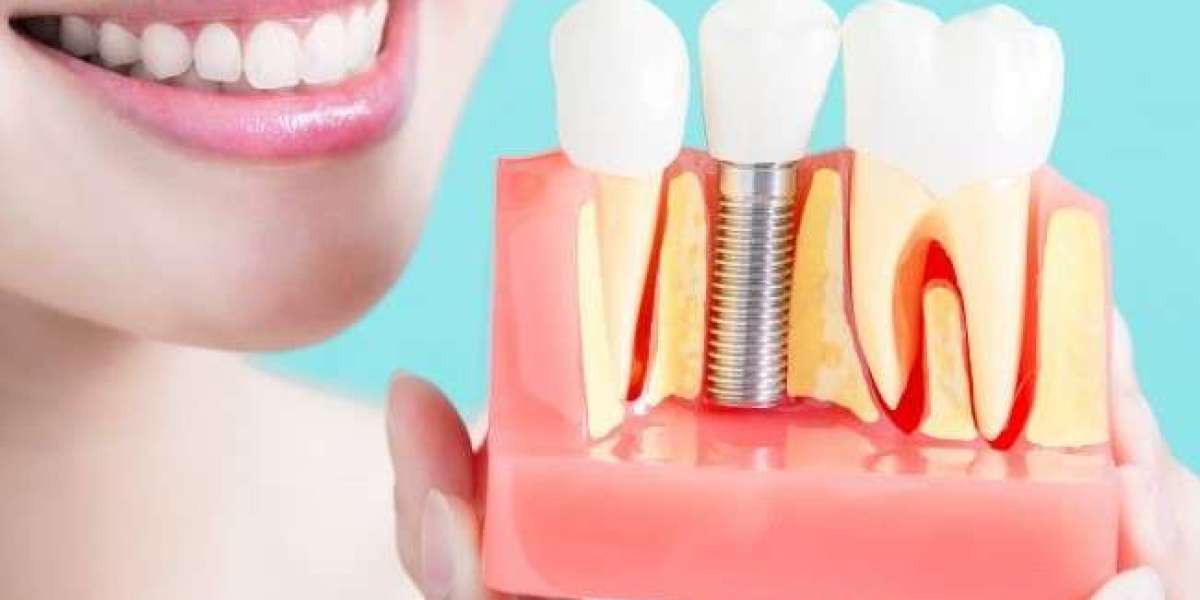 Unlock Your Best Smile: The Ultimate Guide to Dental Implants in Dubai