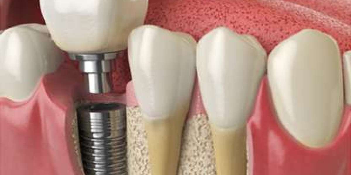 Emerging Trends in Zirconia Implant Technology