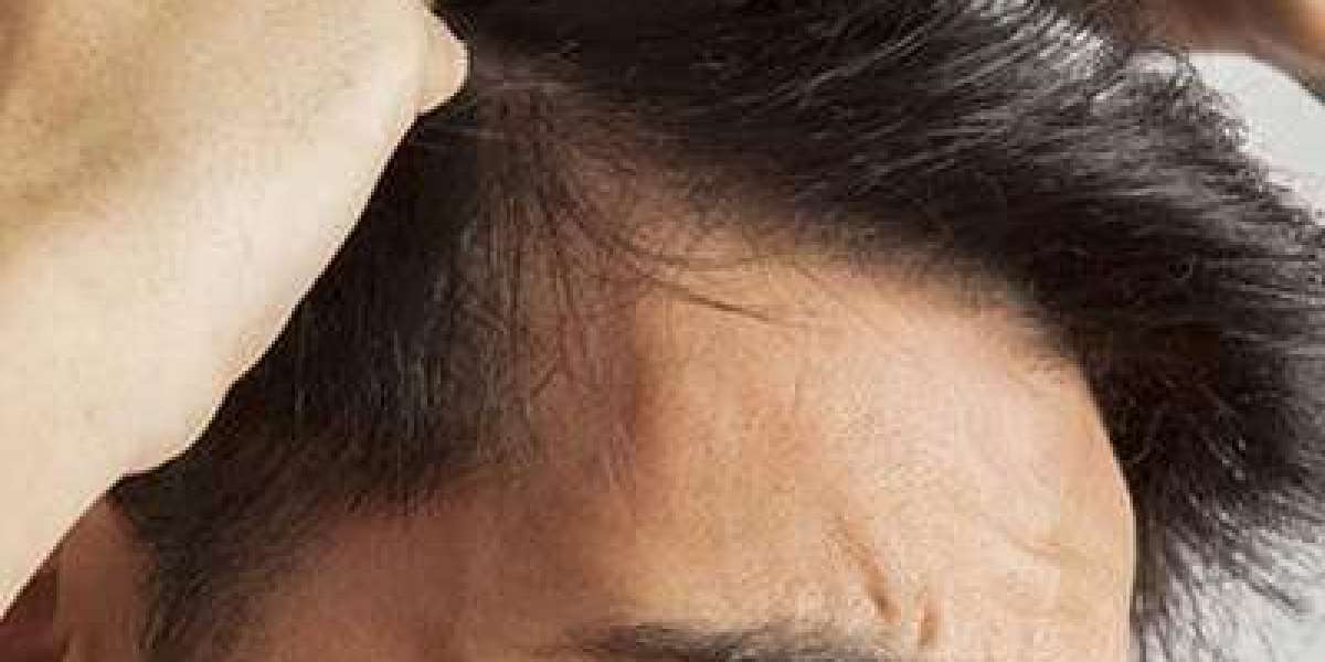 إحياء مظهرك: زراعة الشعر في دبي