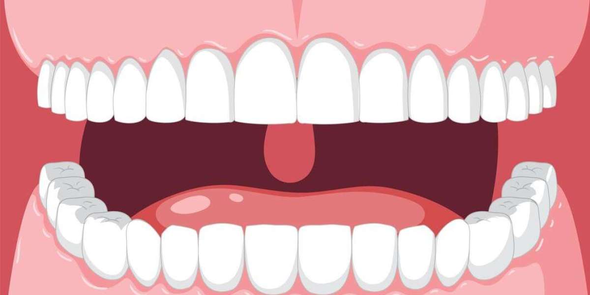 Improving Your Smile with Composite Bonding