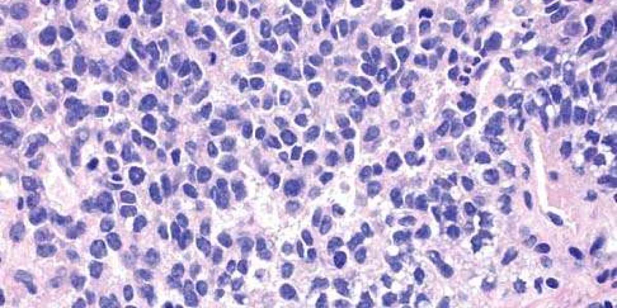 Ewing’s Sarcoma Market Report (2024-2034): Epidemiology, Industry Trends, Share, Size, Demand
