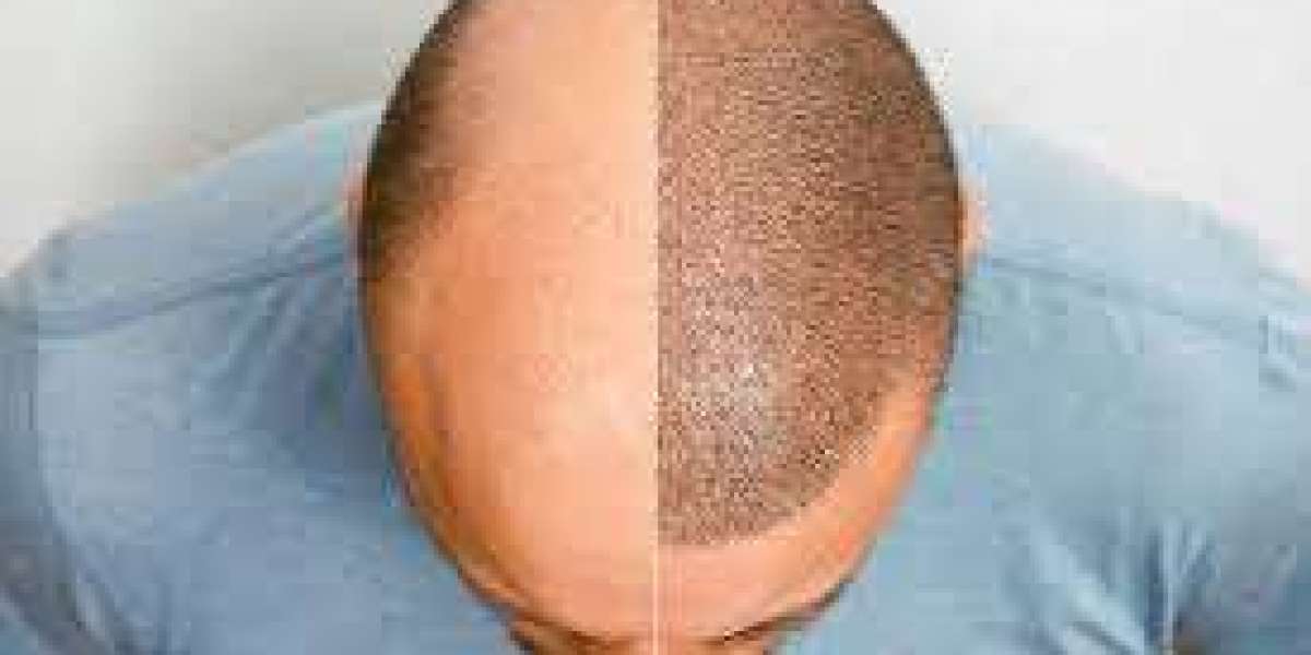 Understanding Hair Transplant Cost in Riyadh: What You Need to Know