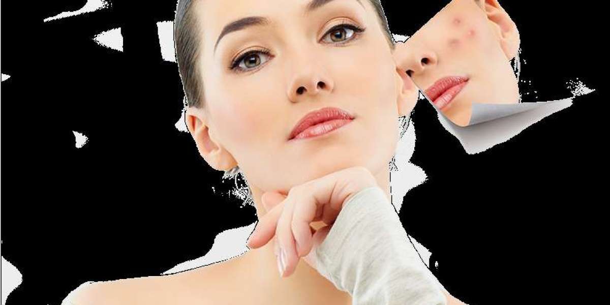 The Science Behind Acne Scars Treatment in Dubai