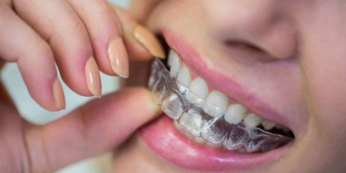 The Cost of Invisalign Treatment: Breaking Down the Expenses