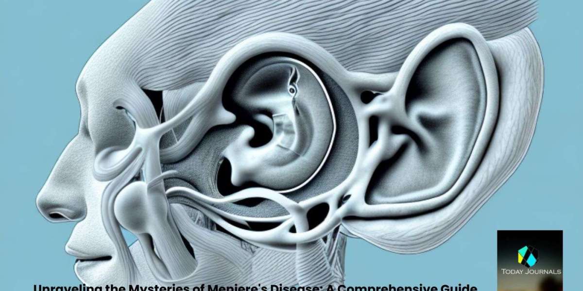 Unraveling the Mysteries of Meniere’s Disease: A Comprehensive Guide