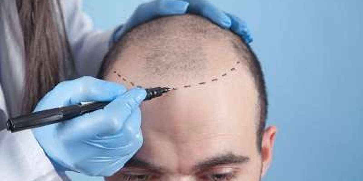 Hair Transplant Cost: Budgeting and Financing Options