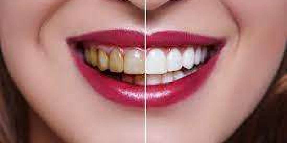 From Dull to Dazzling: The Journey of Teeth Whitening at Enfield Royal Clinic