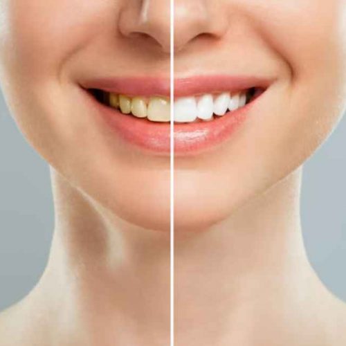 Teeth Whitening Ajman | Teeth Cleaning Ajman
