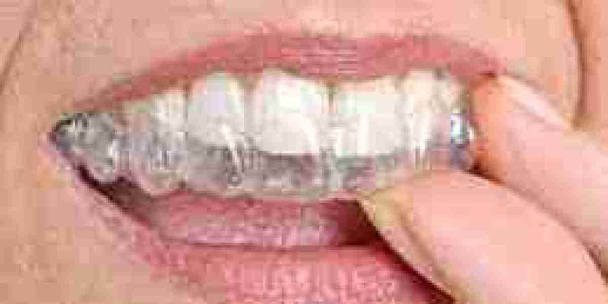 Turbocharge Your Invisalign Experience: Tips for Speedier Tooth Alignment