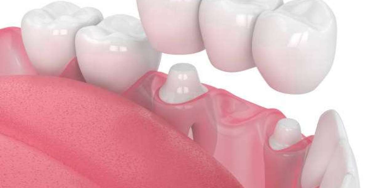 Dental Crown and Bridge Innovations: Advancements in Technology