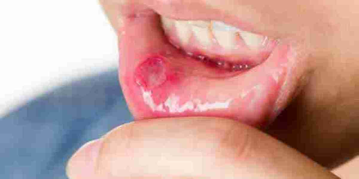 Oral Mucositis Market Size, 2024 Analysis, Industry Trends and Forecasts to 2034