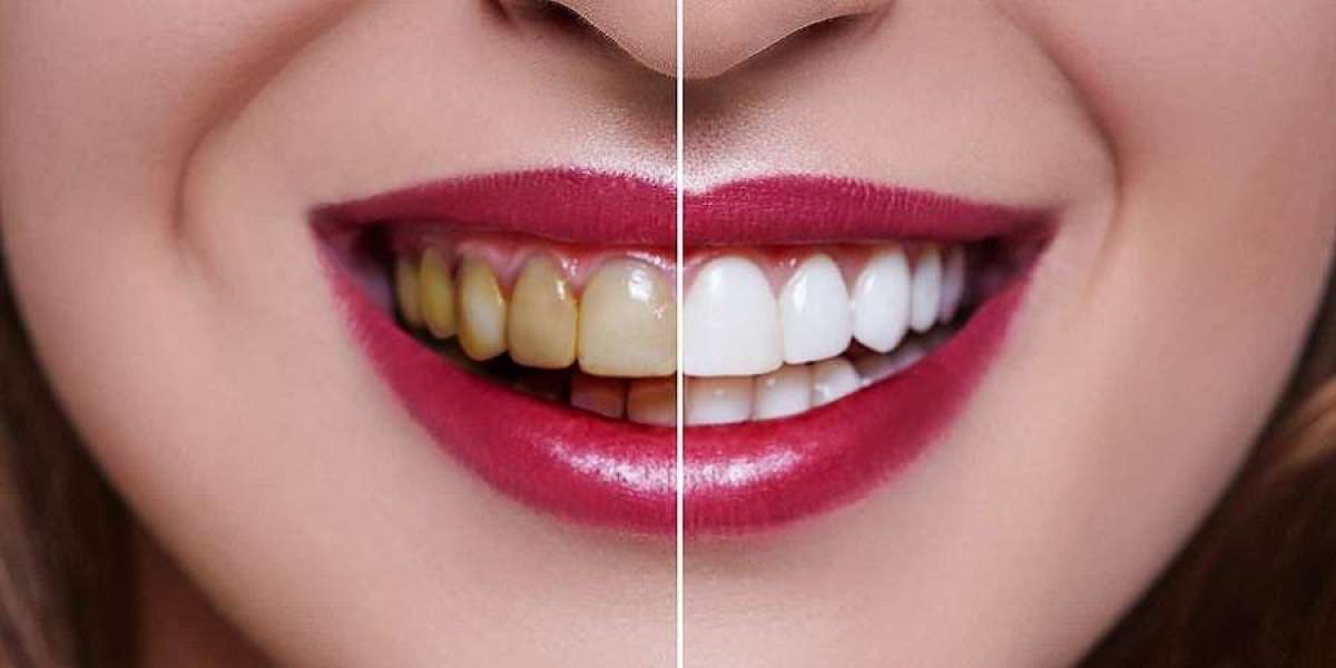 Smile Illumination Riyadh's Supreme Teeth Whitening