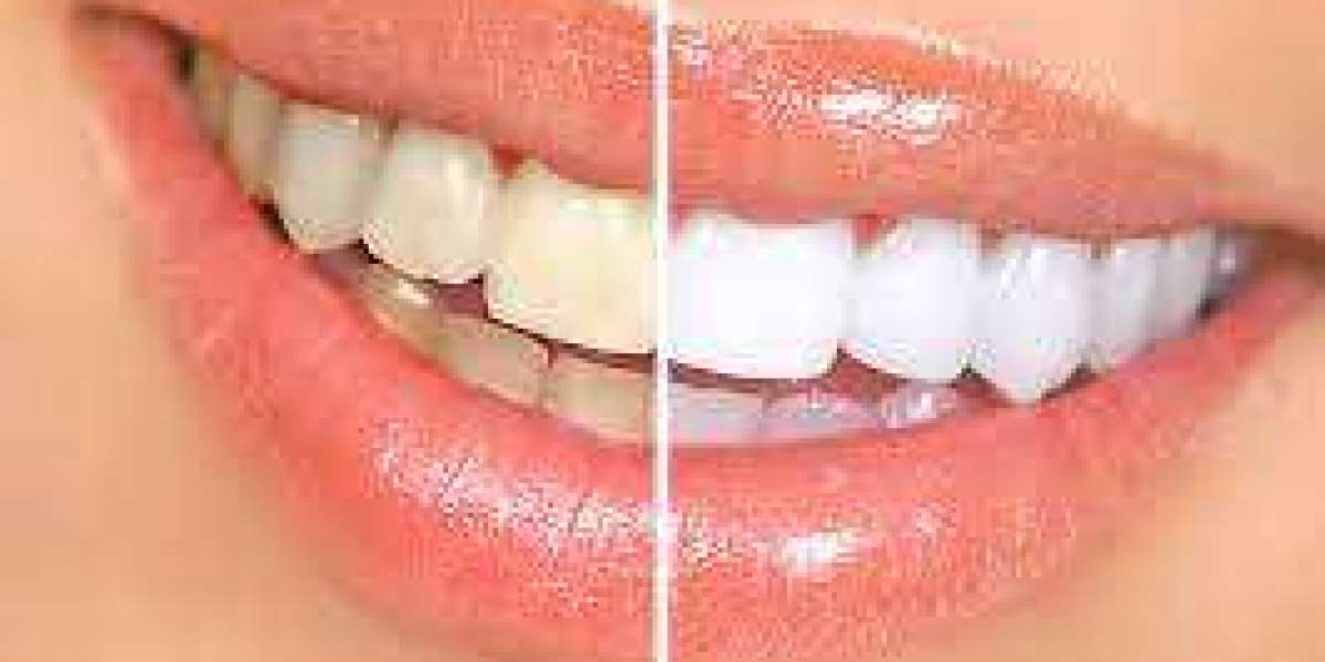 Revitalize Your Smile: A Comprehensive Guide to Teeth Whitening in Riyadh