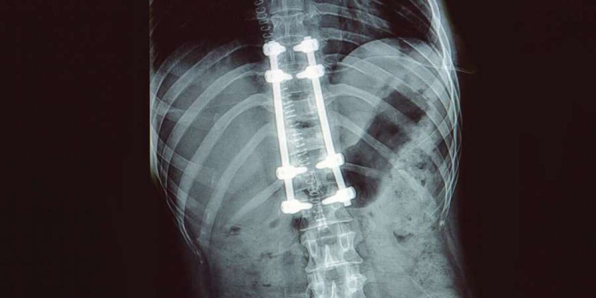 Spinal Implant Market Business Development, Size, Share, Trends, Industry Analysis