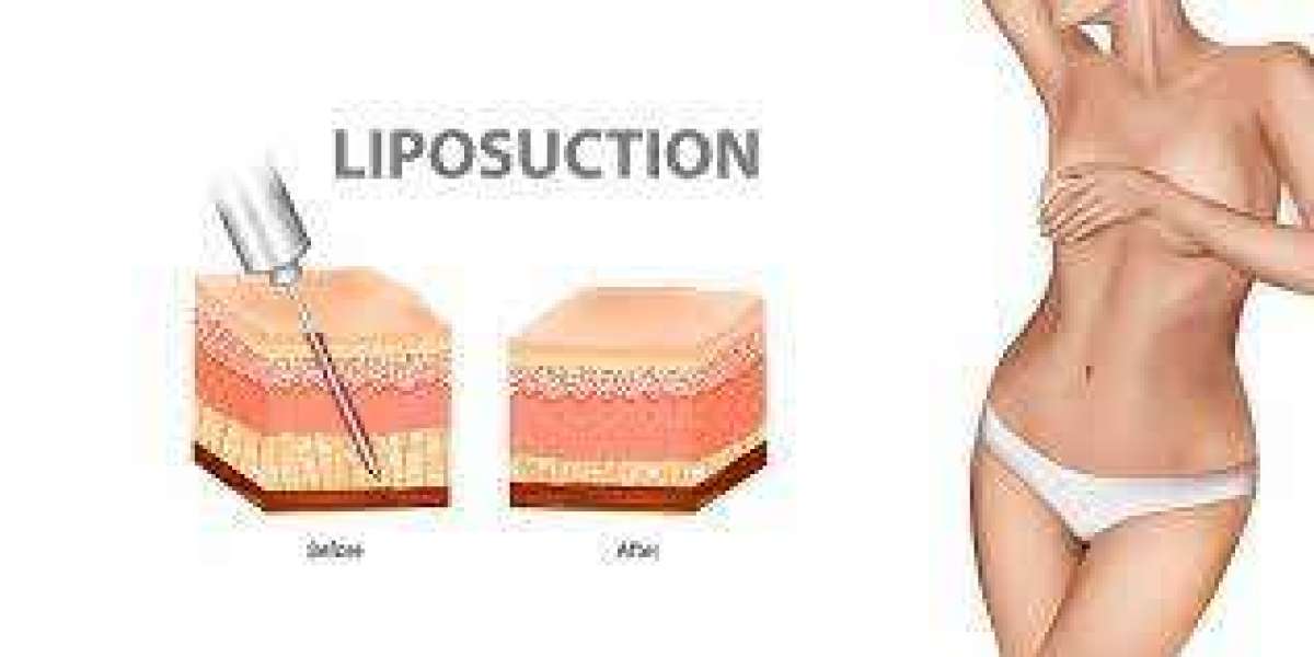 Confidence Redefined: The Growing Trend of Liposuction in Riyadh