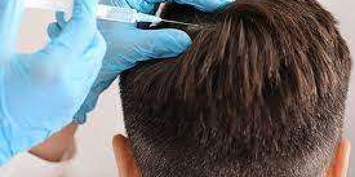 Forever Follicles: Leading Hair Restoration in Dubai