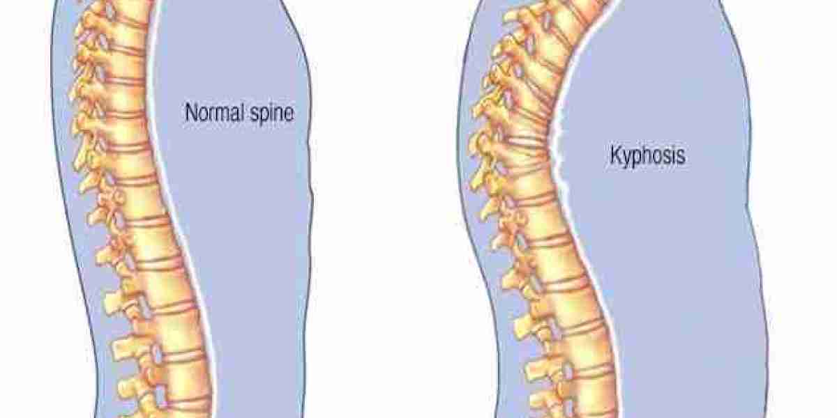 Exploring Affordability: Cost of Spinal Surgery in India