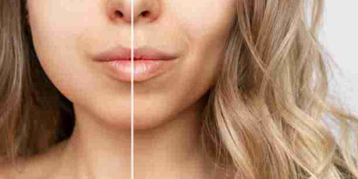 Reveal Your Natural Beauty: Buccal Fat Removal in Abu Dhabi
