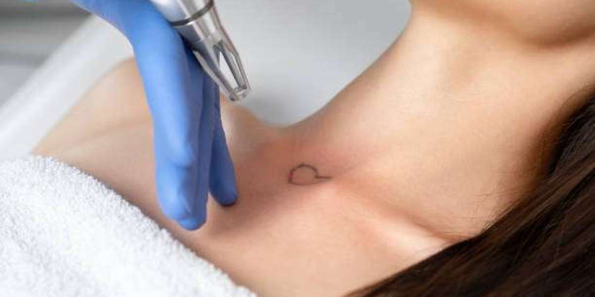 Factors Affecting the Success of Laser Tattoo Removal