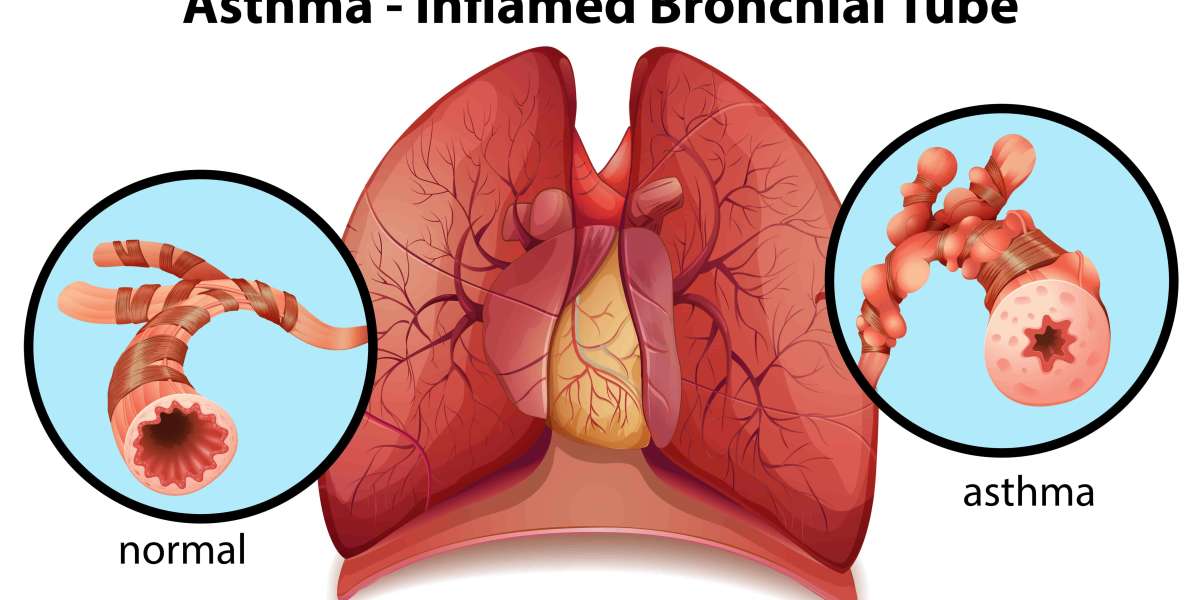 Exploring Home Remedies for Asthma: Enhancing Respiratory Health Naturally