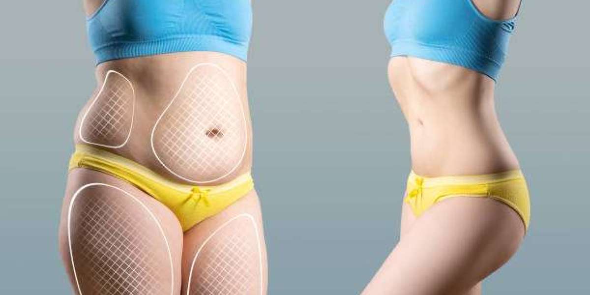 Common Misconceptions About Liposuction in Abu Dhabi Debunked