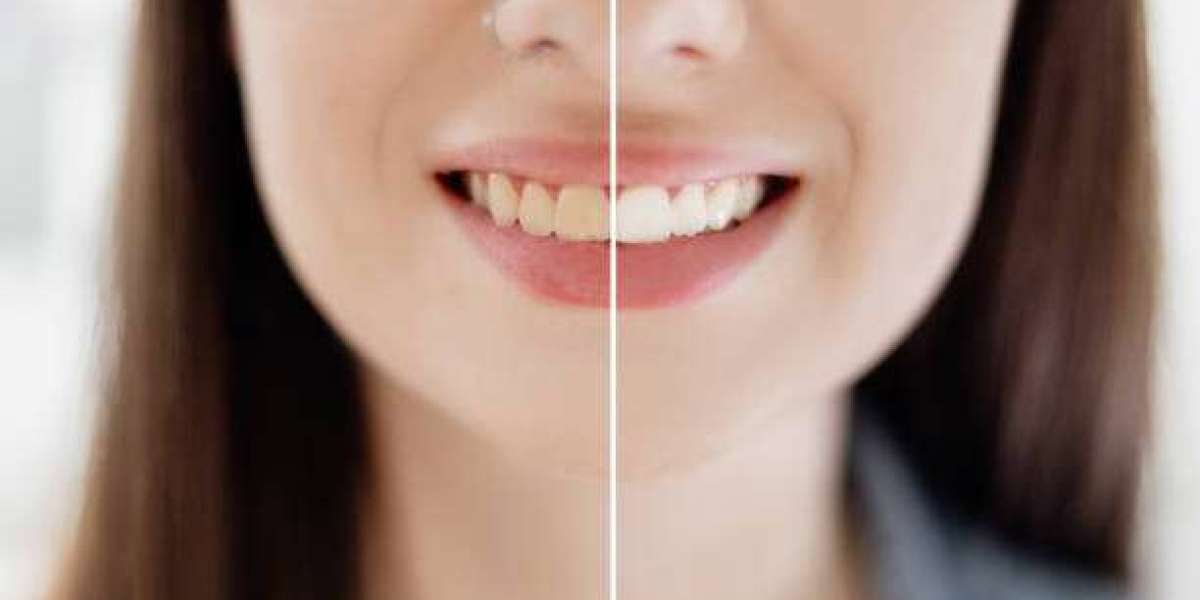 Preparing for Teeth Whitening Treatment: What to Expect